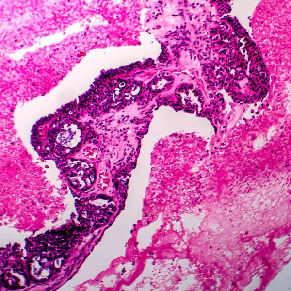 Microscopic view of cancer cells