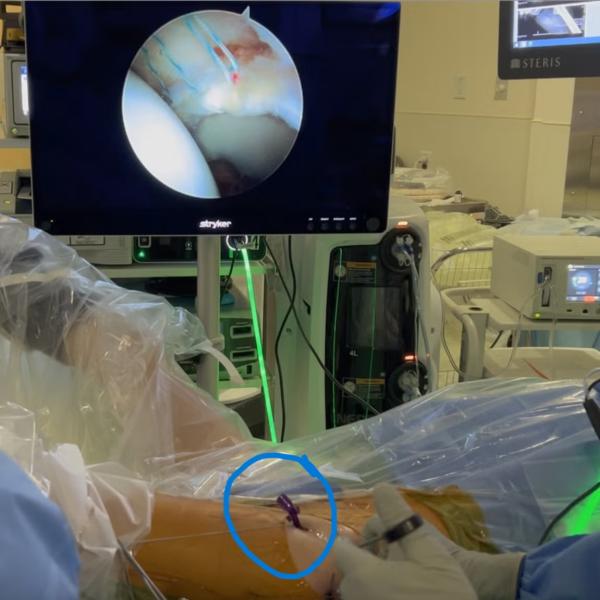 In an operating room, a surgeon performs an arthroscopic procedure on a patient, with the joint displayed on a monitor; surgical instruments and tubing pass through a small incision highlighted by a blue circle.