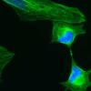 lung cancer